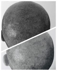 Micropigmentation capillaire, scalp ou tricopigmentation​