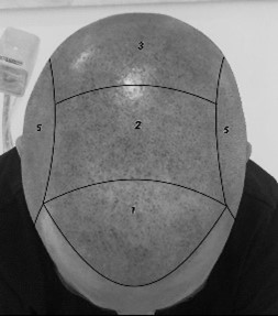 Micropigmentation capillaire, scalp ou tricopigmentation​