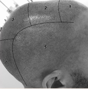 Micropigmentation capillaire, scalp ou tricopigmentation​