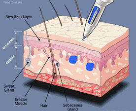 Micropigmentation capillaire, scalp ou tricopigmentation​